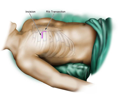 Minimally Invasive Cardiac Surgery